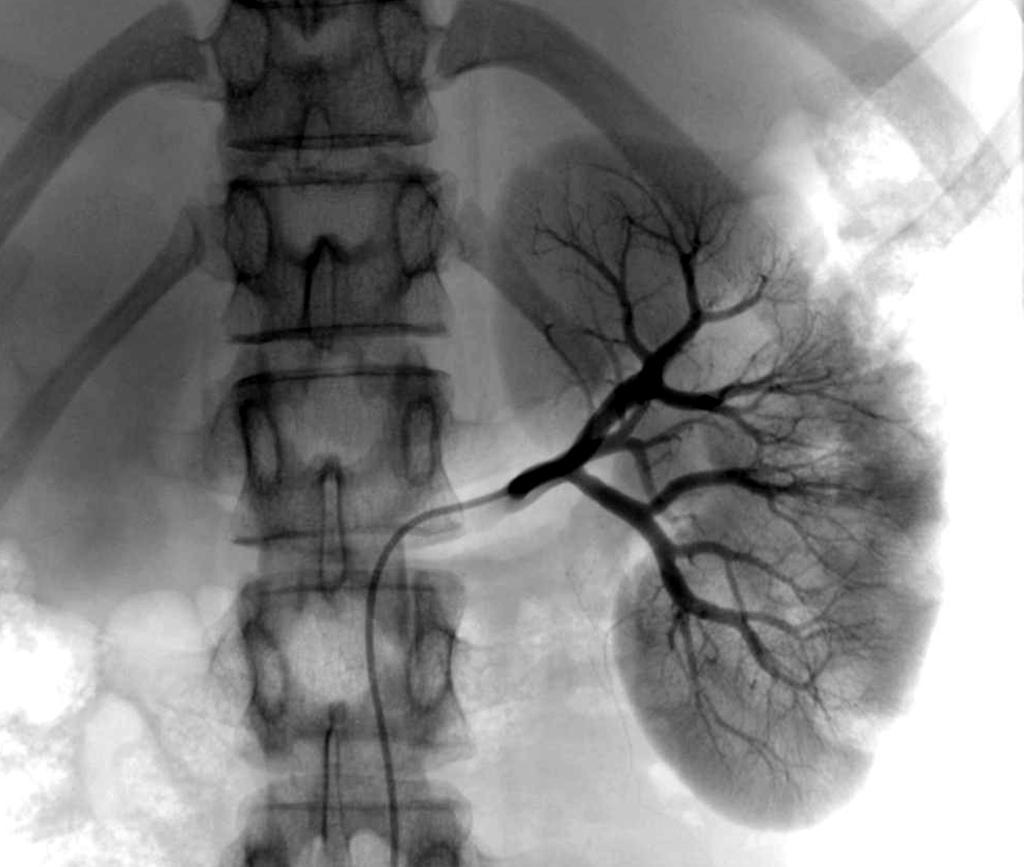 Renal Angiogram